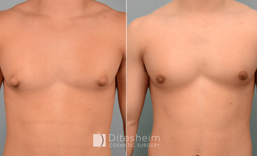 Male's torso before and after Gynecomastia in teens, front view