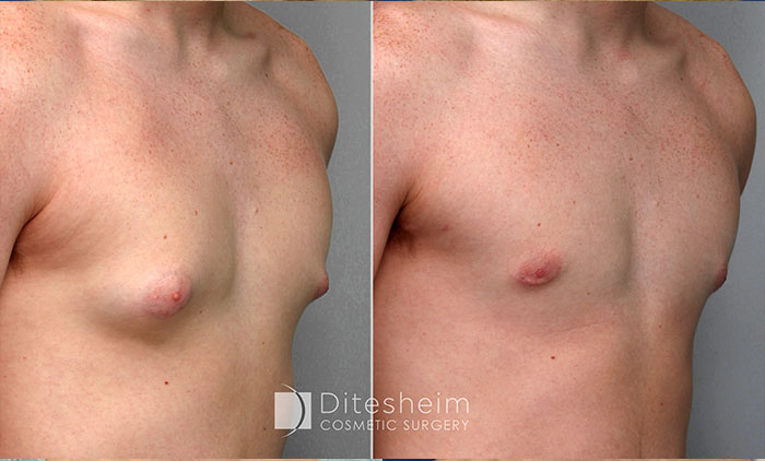 Breast Lift with large or - Ditesheim Cosmetic Surgery