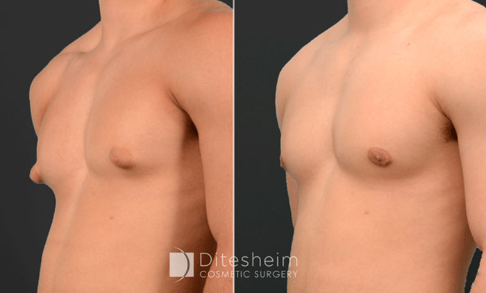 What Next for this Patient: Thirteen-Year-Old Boy With Breast
