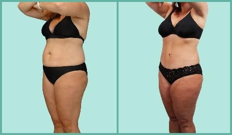 Female's body before and after aquashape liposuction, left angle