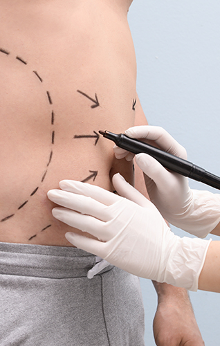 Doctor’s hands marking with arrows and dotted lines, the abdomen of a man prior to surgery