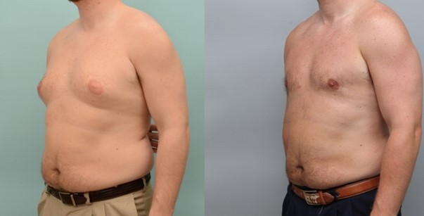 Man's chest before and after gynecomastia, left angle