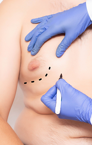 Plastic surgeon preparation, marking the breast of a man