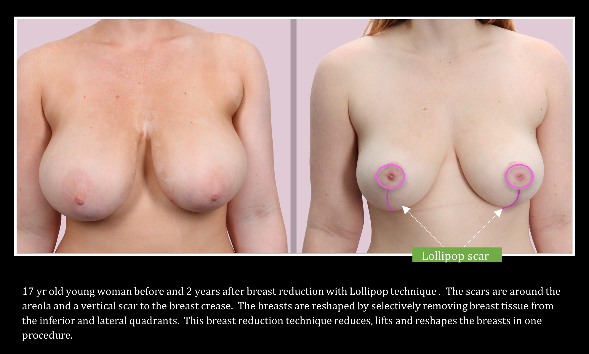 Banner explaining and showing lollipop scar after breast reduction