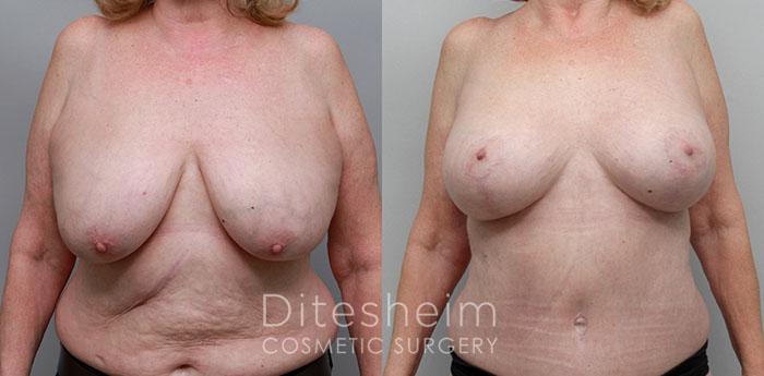 breast lift with implants charlotte