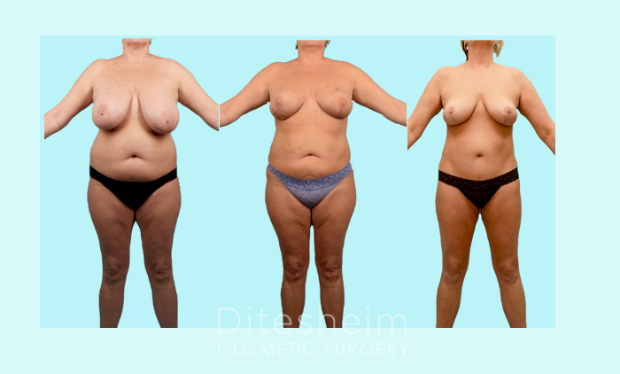 High Definition Liposculpting Before & After Photos Charlotte North Carolina