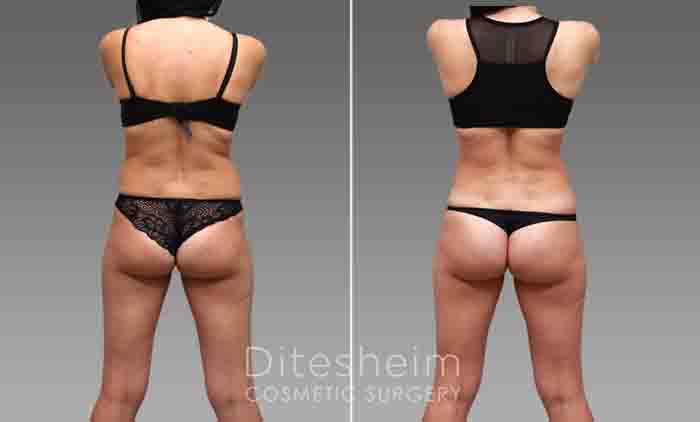 Liposuction by body area Before & After Photos Charlotte North