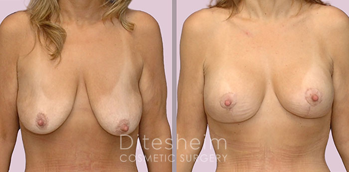 Female's breast before and after breast reduction(lollipop), front view