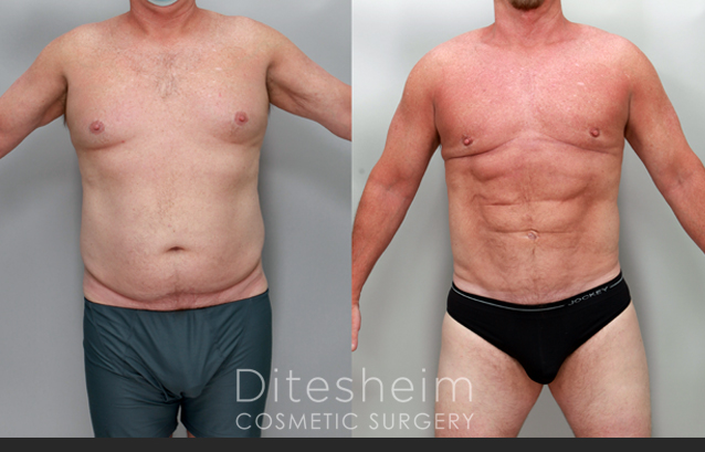 Male Liposuction by body area Before & After Photos Charlotte North Carolina