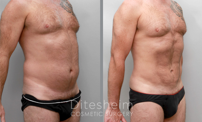 Male Love Handle Liposuction Before & After Photos Charlotte North
