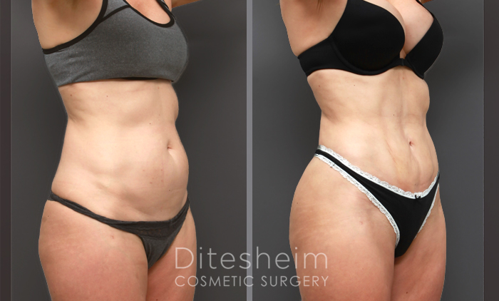 high definition liposuction results