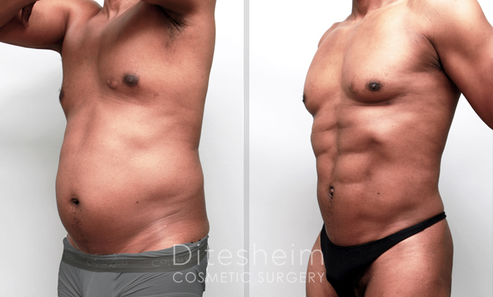 liposuction for obese men