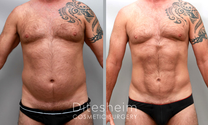 male liposuction results