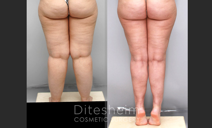 Woman's legs before and after liposculpting thighs, back view