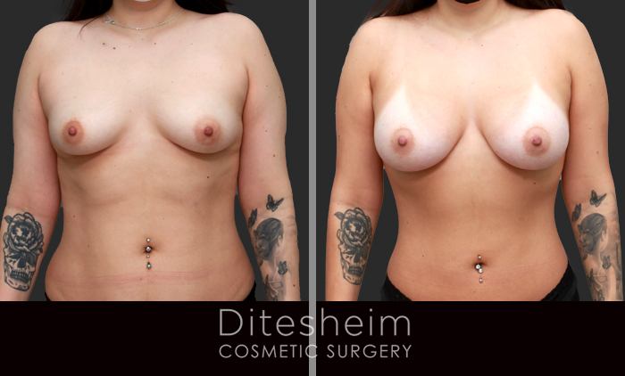 Woman's breasts before and after breast augmentation, front view