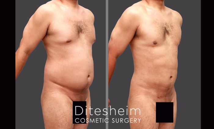 Vaser Liposuction for Men Before & After Photos Charlotte North