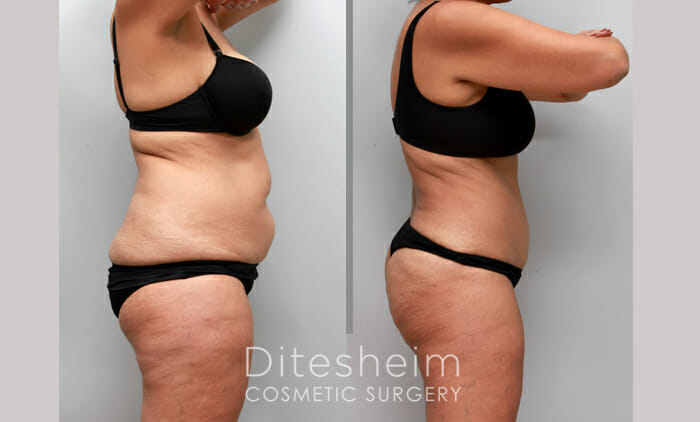 Ozempic vs. VASER Liposuction: Here's How to Choose - 360 Plastic Surgery