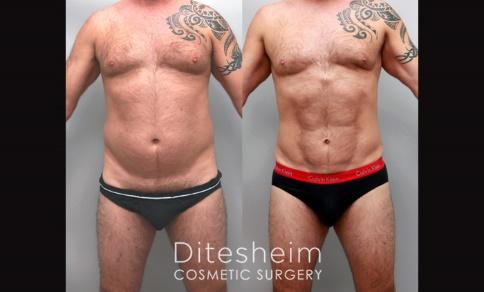 vaser liposuction with high definition approach 