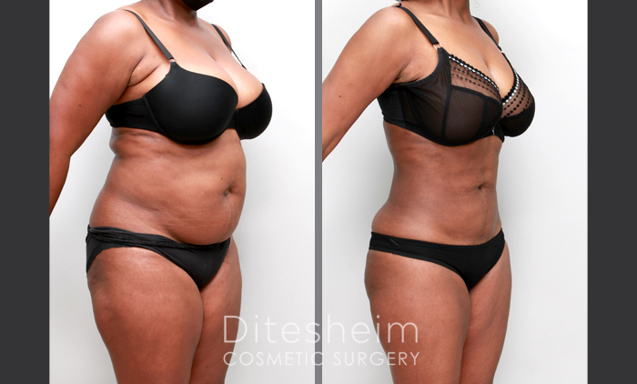 360 Post Op Lose Fat Slimming Surgical Lipo Recovery High