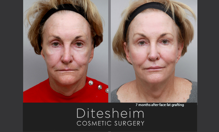 Breast lift with fat grafting - Ditesheim Cosmetic Surgery