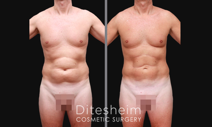 Male Liposuction by body area Before & After Photos Charlotte North Carolina