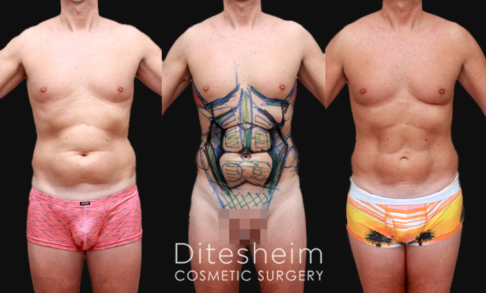 Liposuction for Men: Breaking Stereotypes & Sculpting Bodies
