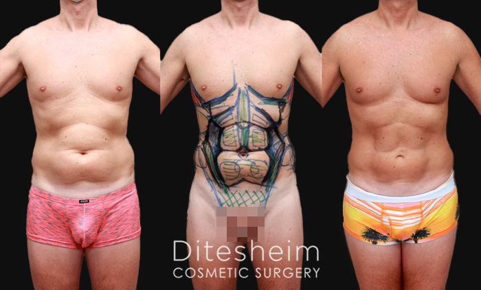 Male Love Handle Liposuction Before & After Photos Charlotte North Carolina