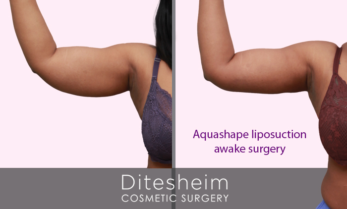 Exploring the Different Types of Arm Liposuction to Achieve Desired Results  - Atlanta Liposuction Specialty Clinic