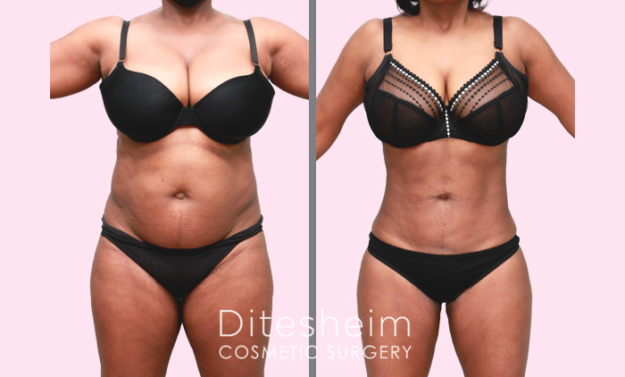 Liposculpture and Liposuction Before and After