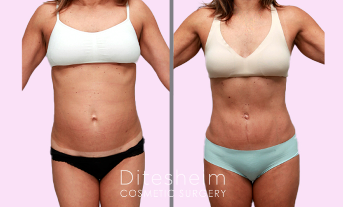 Tummy Tuck Before and After Pictures Case 364