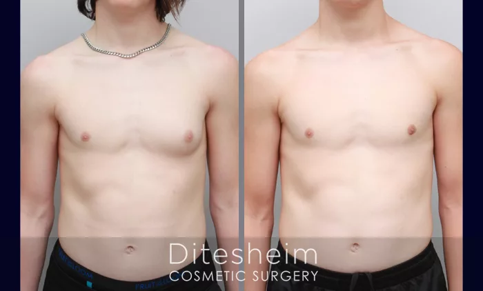 Gynecomastia Before & After Photos Charlotte North Carolina