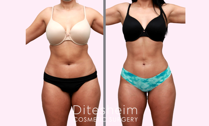 Breast lift with fat grafting - Ditesheim Cosmetic Surgery