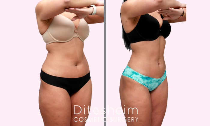 Smart Lipo 360, Liposuction, Before and After