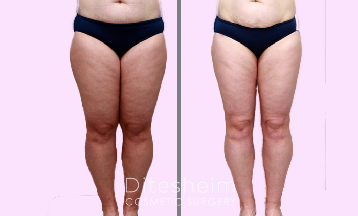 Liposuction by body area Before & After Photos Charlotte North Carolina