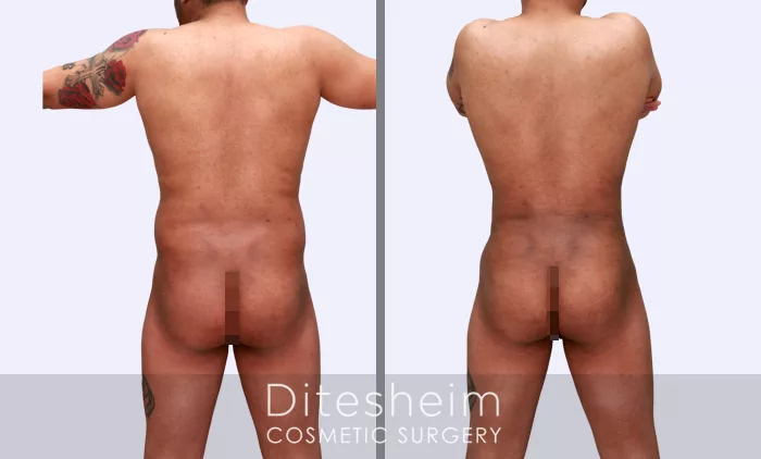 Male Love Handle Liposuction Before & After Photos Charlotte North Carolina