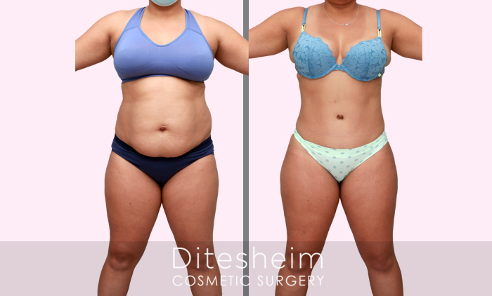 Transformation of the Week: Non-Invasive Mommy Tuck - The Body Squad