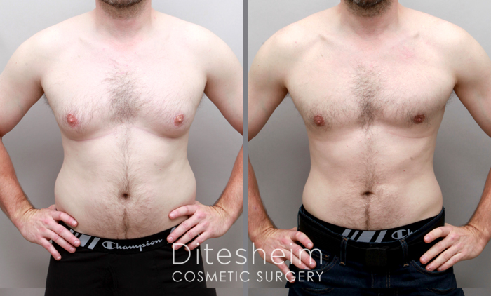 34 YO, 2 Kids, 38H, Breast Reduction and Lipo for Abdominal and