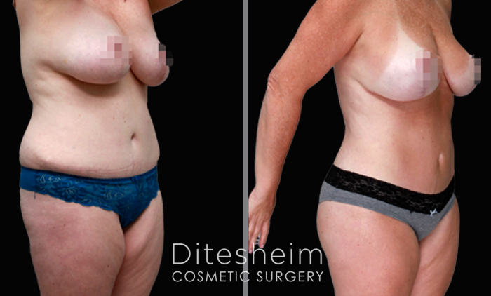 Double Bra Breast Lift Surgery in Portland -Hillsboro Oregon - Mastopexy