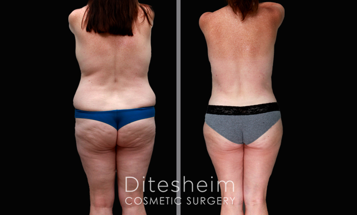 Liposuction Waist and Back Before & After Photos Charlotte North