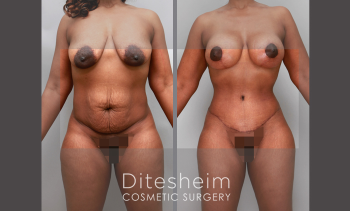Patient C - 3 months Post-Operative Tummy Tuck Frontal View — Dr