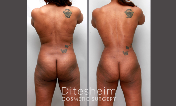 A, C, E) This 53-year-old woman presented for body contouring. (B