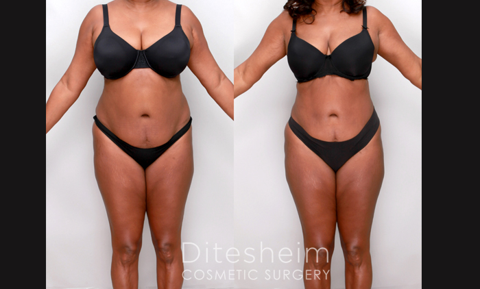 Lipo360 - Lipo 360 Before After Before & After Photos Charlotte