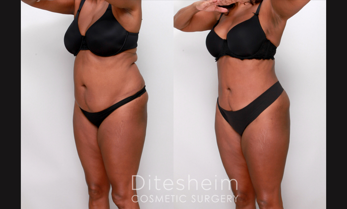 SlimSculpt360 Lipo Dissolve - Fit Body Weight Loss
