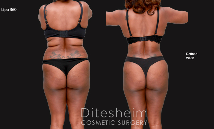 Liposuction Waist and Back Before & After Photos Charlotte North Carolina