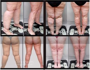 a person's legs before and after a lipedema procedure