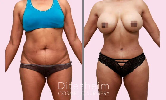 Tummy-tuck-and-breast-augmentation-woman-of-color-Front-view