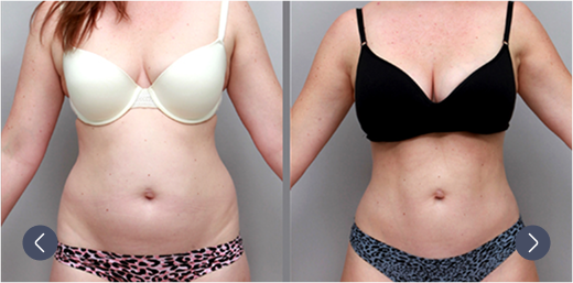 Before and after photo of breast augmentation results – Ditesheim Cosmetic Surgery