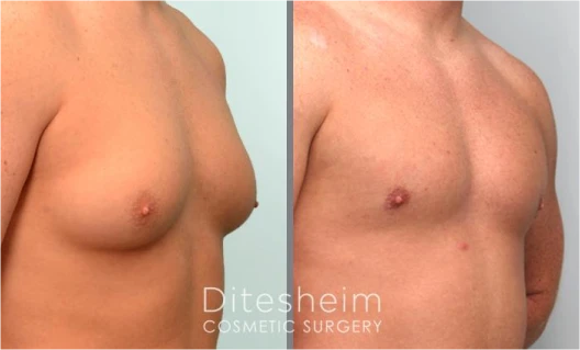 Male gynecomastia surgery before and after showing flatter chest contour | Ditesheim Cosmetic Surgery Charlotte