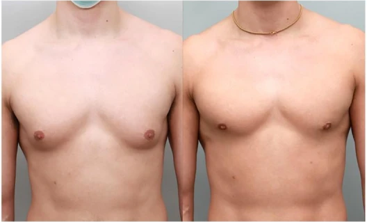 Before and after gynecomastia surgery results showing improved, natural chest contour