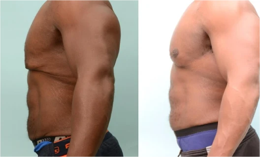 Male chest reduction before and after photo showing balanced, natural results | Ditesheim Cosmetic Surgery Charlotte